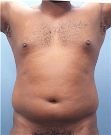 Male Breast Reduction Before Photo by Marvin Shienbaum, MD; Brandon, FL - Case 34905