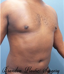 Male Breast Reduction After Photo by Marvin Shienbaum, MD; Brandon, FL - Case 34905