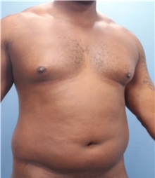 Male Breast Reduction Before Photo by Marvin Shienbaum, MD; Brandon, FL - Case 34905