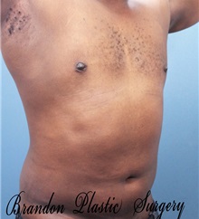 Male Breast Reduction After Photo by Marvin Shienbaum, MD; Brandon, FL - Case 34905