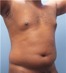 Male Breast Reduction Before Photo by Marvin Shienbaum, MD; Brandon, FL - Case 34905