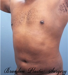 Male Breast Reduction After Photo by Marvin Shienbaum, MD; Brandon, FL - Case 34905