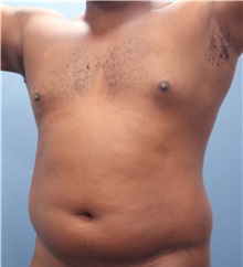 Male Breast Reduction Before Photo by Marvin Shienbaum, MD; Brandon, FL - Case 34905