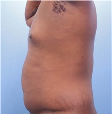 Male Breast Reduction Before Photo by Marvin Shienbaum, MD; Brandon, FL - Case 34905