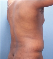 Male Breast Reduction Before Photo by Marvin Shienbaum, MD; Brandon, FL - Case 34905