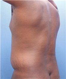 Male Breast Reduction Before Photo by Marvin Shienbaum, MD; Brandon, FL - Case 34905