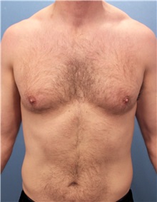 Male Breast Reduction Before Photo by Marvin Shienbaum, MD; Brandon, FL - Case 34906