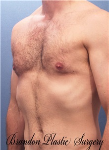 Male Breast Reduction After Photo by Marvin Shienbaum, MD; Brandon, FL - Case 34906