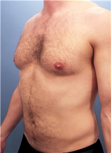 Male Breast Reduction Before Photo by Marvin Shienbaum, MD; Brandon, FL - Case 34906