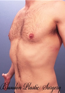 Male Breast Reduction After Photo by Marvin Shienbaum, MD; Brandon, FL - Case 34906