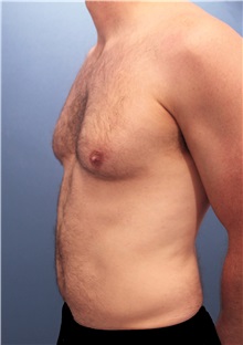 Male Breast Reduction Before Photo by Marvin Shienbaum, MD; Brandon, FL - Case 34906