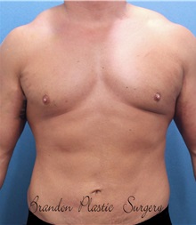 Male Breast Reduction After Photo by Marvin Shienbaum, MD; Brandon, FL - Case 34907