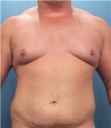 Male Breast Reduction Before Photo by Marvin Shienbaum, MD; Brandon, FL - Case 34907