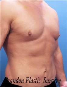 Male Breast Reduction After Photo by Marvin Shienbaum, MD; Brandon, FL - Case 34907