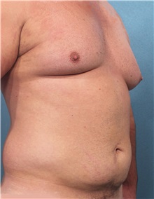 Male Breast Reduction Before Photo by Marvin Shienbaum, MD; Brandon, FL - Case 34907