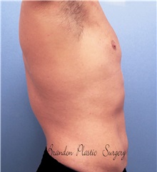 Male Breast Reduction After Photo by Marvin Shienbaum, MD; Brandon, FL - Case 34907