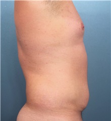 Male Breast Reduction Before Photo by Marvin Shienbaum, MD; Brandon, FL - Case 34907