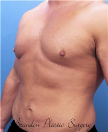 Male Breast Reduction After Photo by Marvin Shienbaum, MD; Brandon, FL - Case 34907