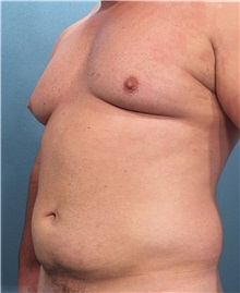 Male Breast Reduction Before Photo by Marvin Shienbaum, MD; Brandon, FL - Case 34907