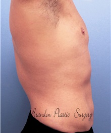 Male Breast Reduction After Photo by Marvin Shienbaum, MD; Brandon, FL - Case 34907