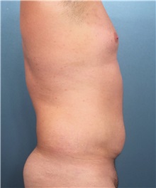 Male Breast Reduction Before Photo by Marvin Shienbaum, MD; Brandon, FL - Case 34907