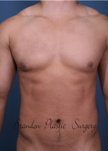 Male Breast Reduction After Photo by Marvin Shienbaum, MD; Brandon, FL - Case 34908