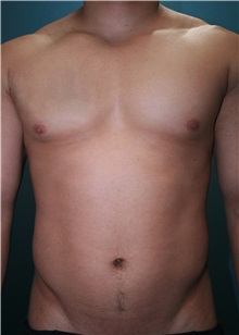 Male Breast Reduction Before Photo by Marvin Shienbaum, MD; Brandon, FL - Case 34908