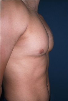 Male Breast Reduction After Photo by Marvin Shienbaum, MD; Brandon, FL - Case 34908