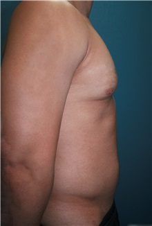 Male Breast Reduction Before Photo by Marvin Shienbaum, MD; Brandon, FL - Case 34908