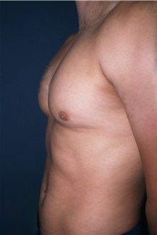 Male Breast Reduction After Photo by Marvin Shienbaum, MD; Brandon, FL - Case 34908