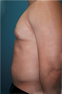 Male Breast Reduction Before Photo by Marvin Shienbaum, MD; Brandon, FL - Case 34908