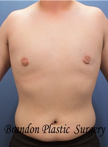 Male Breast Reduction After Photo by Marvin Shienbaum, MD; Brandon, FL - Case 34909