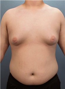 Male Breast Reduction Before Photo by Marvin Shienbaum, MD; Brandon, FL - Case 34909