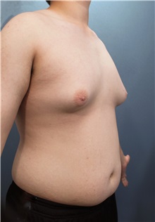 Male Breast Reduction Before Photo by Marvin Shienbaum, MD; Brandon, FL - Case 34909