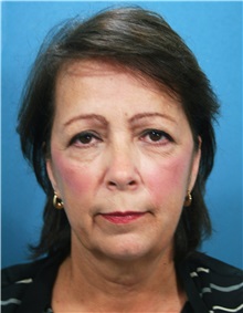 Facelift Before Photo by Marvin Shienbaum, MD; Brandon, FL - Case 34974