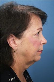 Facelift Before Photo by Marvin Shienbaum, MD; Brandon, FL - Case 34974