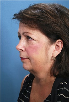 Facelift Before Photo by Marvin Shienbaum, MD; Brandon, FL - Case 34974