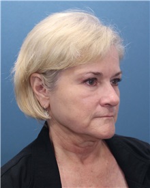Facelift Before Photo by Marvin Shienbaum, MD; Brandon, FL - Case 34975