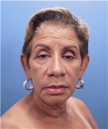 Facelift Before Photo by Marvin Shienbaum, MD; Brandon, FL - Case 34977