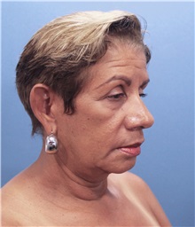 Facelift Before Photo by Marvin Shienbaum, MD; Brandon, FL - Case 34977