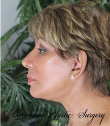 Facelift After Photo by Marvin Shienbaum, MD; Brandon, FL - Case 34977