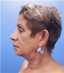 Facelift Before Photo by Marvin Shienbaum, MD; Brandon, FL - Case 34977