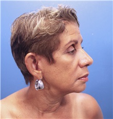 Facelift Before Photo by Marvin Shienbaum, MD; Brandon, FL - Case 34977