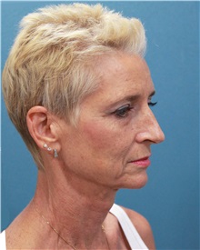 Facelift Before Photo by Marvin Shienbaum, MD; Brandon, FL - Case 34978