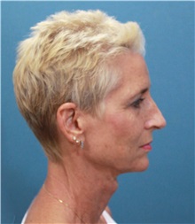 Facelift Before Photo by Marvin Shienbaum, MD; Brandon, FL - Case 34978