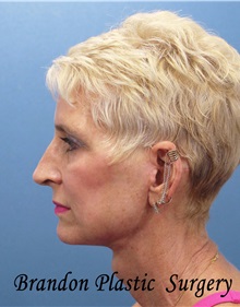 Facelift After Photo by Marvin Shienbaum, MD; Brandon, FL - Case 34978