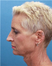 Facelift Before Photo by Marvin Shienbaum, MD; Brandon, FL - Case 34978