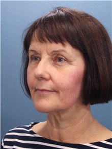 Facelift Before Photo by Marvin Shienbaum, MD; Brandon, FL - Case 34983