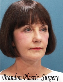 Facelift After Photo by Marvin Shienbaum, MD; Brandon, FL - Case 34983