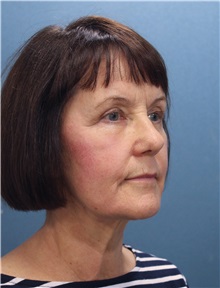 Facelift Before Photo by Marvin Shienbaum, MD; Brandon, FL - Case 34983